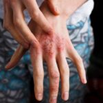 Closeup men itching and scratching by hand. Psoriasis or eczema on the hand. Atopic allergy skin with red spots